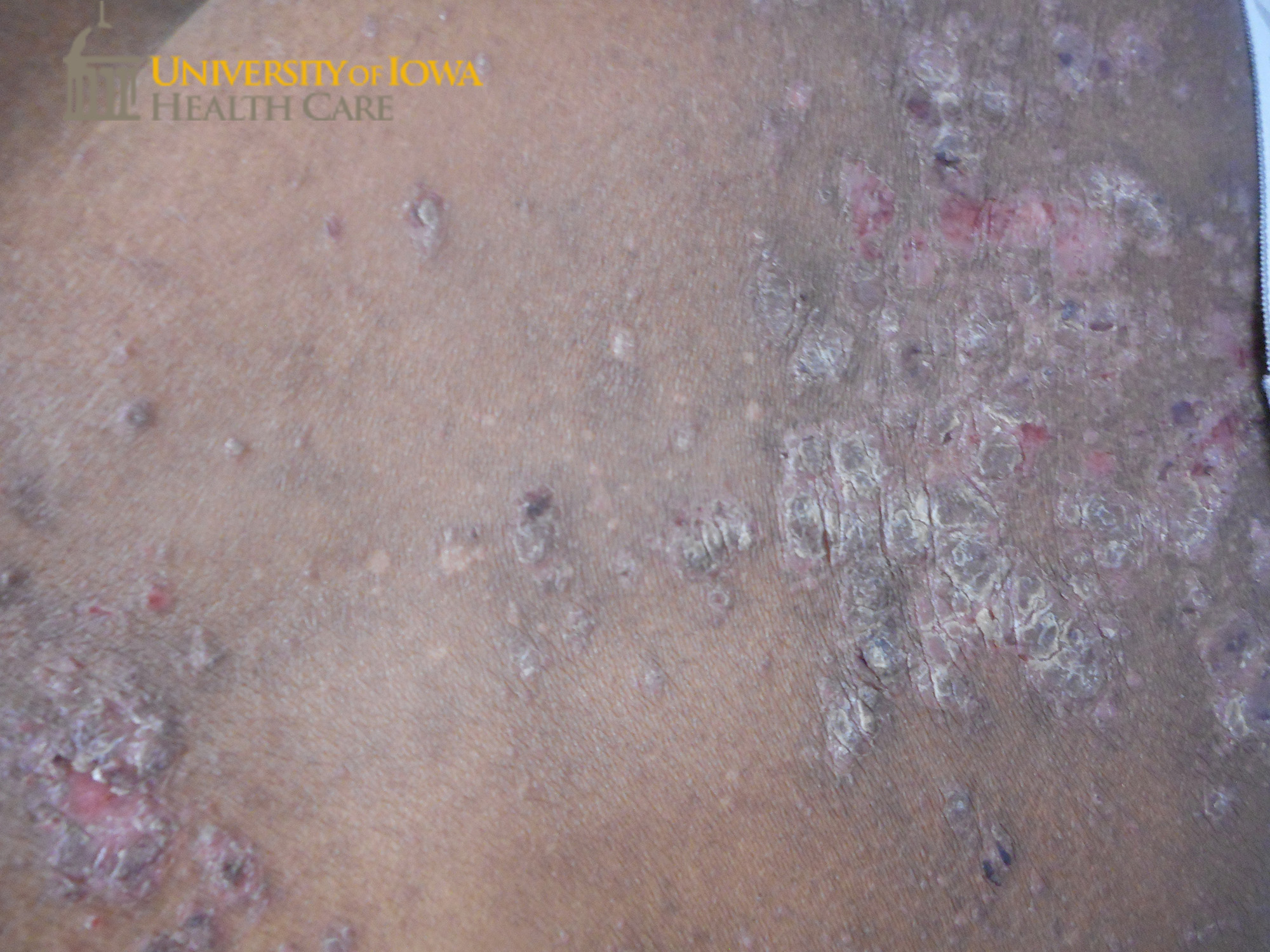 Pink to gray thick scaly papules and plaques on the back. (click images for higher resolution).